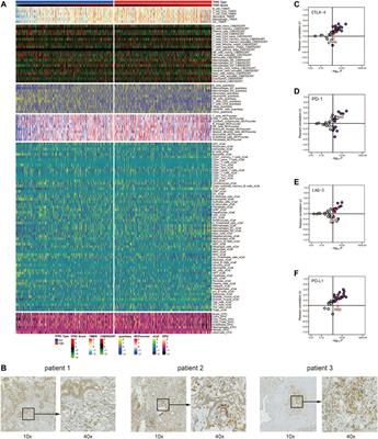 Role of TFRC as a Novel Prognostic Biomarker and in Immunotherapy for Pancreatic Carcinoma